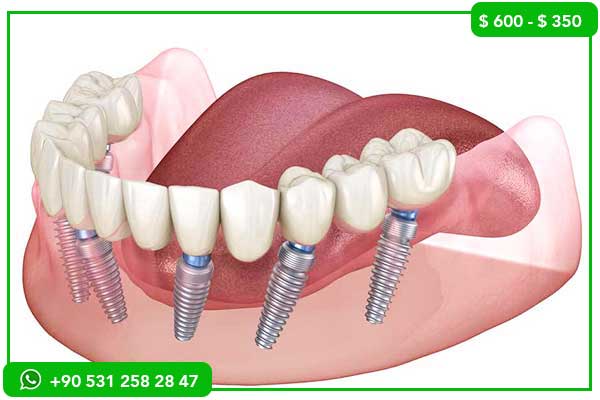 Prix des implants dentaires au Royaume-Uni vs Turquie – Pourquoi choisir la Turquie ?