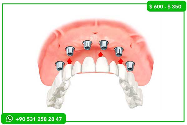 Precios de Implantes Dentales en Italia vs. Turquía – 7 Razones para Elegir Turquía