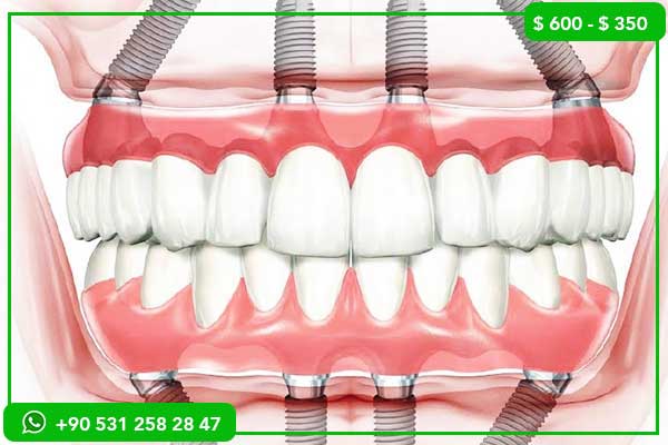 Precios de los implantes dentales en España vs Turquía – 7 razones para elegir Turquía