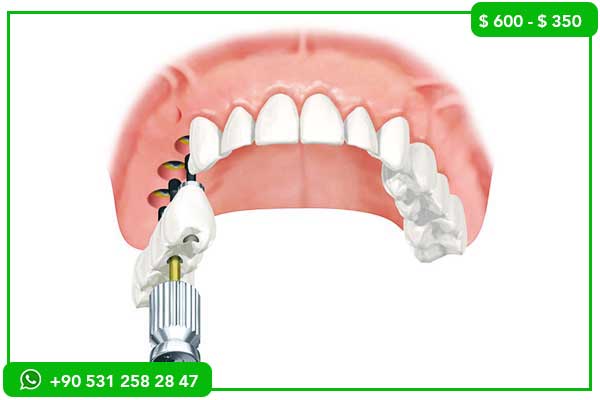 Prix des implants dentaires au Portugal vs Turquie – 7 raisons de choisir la Turquie !