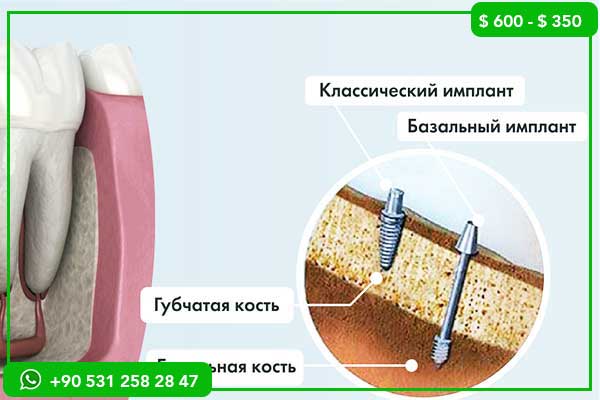 Цены на зубные импланты в Швеции и Турции – Почему стоит выбрать Турцию?