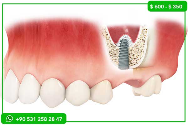 Precios de Implantes Dentales en Noruega vs Turquía – 7 Razones para Elegir Turquía