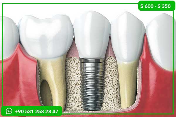 Precios de Implantes Dentales en Kuwait vs. Turquía – 7 Razones para Elegir Turquía