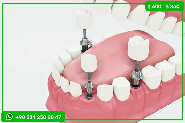 Precios de Implantes Dentales en Baréin vs Turquía – 7 Razones para Elegir Turquía