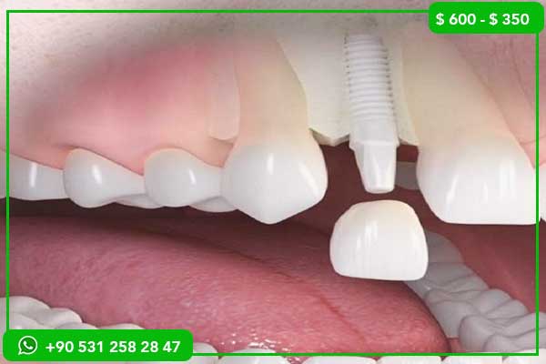 Prezzi degli impianti dentali in Oman vs Turchia – Perché scegliere la Turchia?