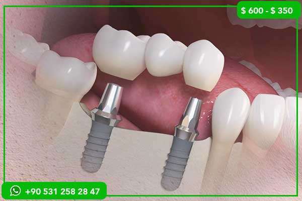 Prezzi degli impianti dentali in Yemen vs Turchia – Perché scegliere la Turchia?