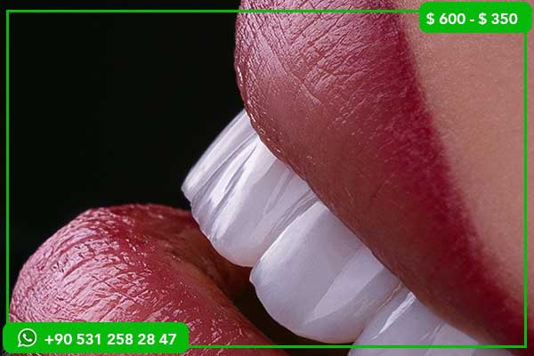 Dental Veneers Prices in Saudi Arabia vs Turkey – 7 Reasons to Choose Turkey!