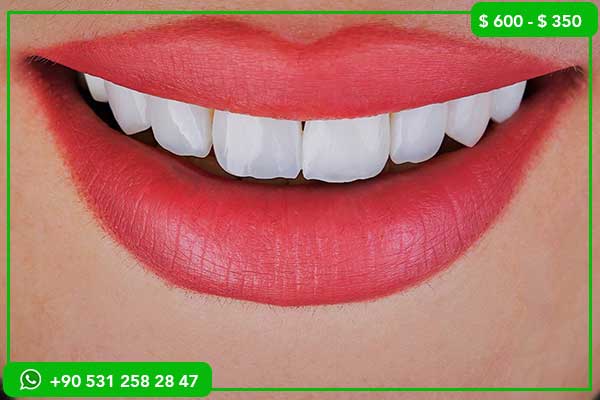 Preise für Zahnveneers im Vereinigten Königreich vs. Türkei – Warum die Türkei wählen?