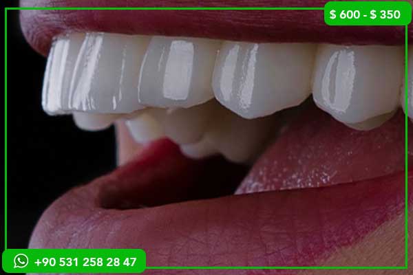 Prezzi delle Faccette Dentali in Italia vs Turchia – 7 Motivi per Scegliere la Turchia!