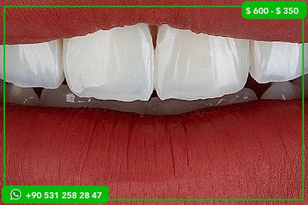 Dental Veneers Prices in Spain vs Turkey – 7 Reasons to Choose Turkey