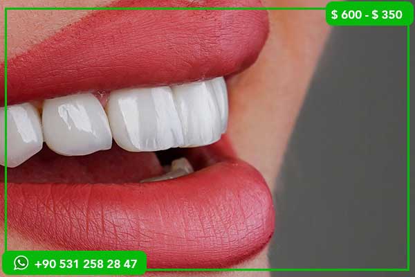 Dental Veneers Prices in Russia vs Turkey – 7 Reasons to Choose Turkey!