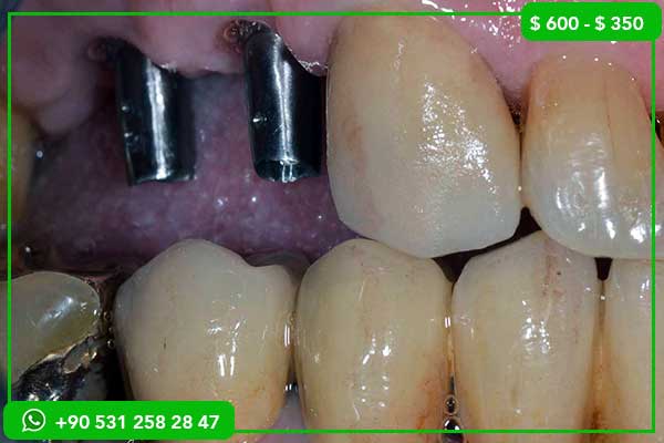 Precios de Implantes Dentales en Bielorrusia vs Turquía – 7 Razones para Elegir Turquía