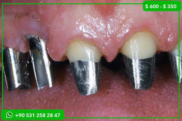 Precios de implantes dentales en Australia vs Turquía – 7 razones para elegir Turquía