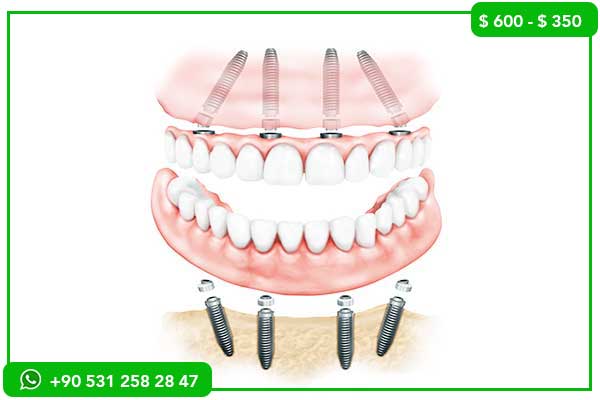 Zahnimplantat-Preise in Kanada vs. Türkei – 7 Gründe, warum die Türkei die bessere Wahl ist!