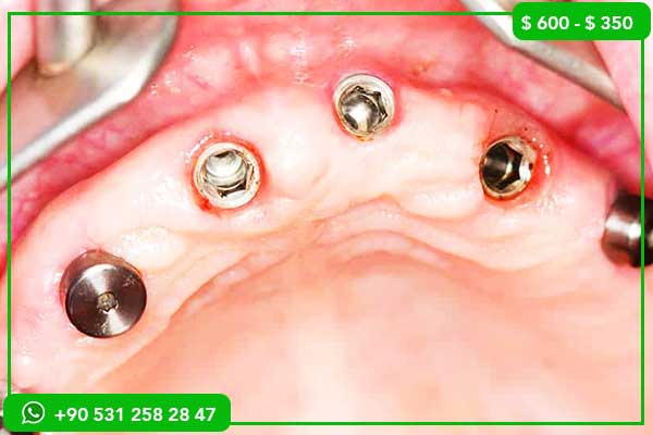 أسعار زراعة الأسنان في الولايات المتحدة مقابل تركيا – 7 أسباب تجعل تركيا الخيار الأفضل