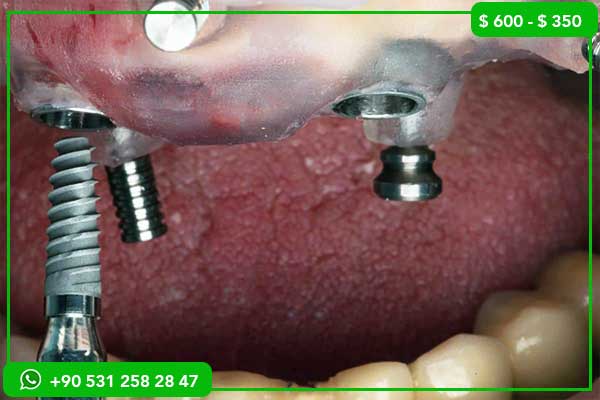 Dental Implant Prices in Ukraine vs Turkey – 7 Reasons to Choose Turkey for Your Perfect Smile!