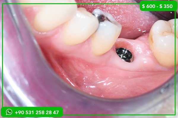 Precios de implantes dentales en Dinamarca vs. Turquía – ¡7 Razones para Elegir Turquía!