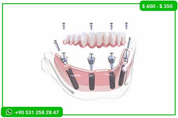 أسعار زراعة الأسنان في روسيا مقابل تركيا – 7 أسباب لاختيار تركيا!