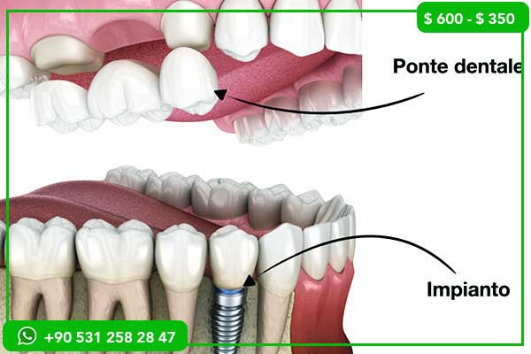 أسعار زراعة الأسنان في رومانيا مقابل تركيا – 7 أسباب لاختيار تركيا لابتسامتك