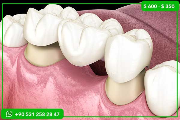 Dental Implant Prices in the Czech Republic vs Turkey – 7 Reasons Why Turkey Is the Best Choice