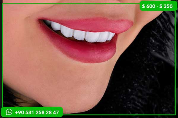 Dental Veneers Prices in the United States vs. Turkey – 7 Reasons to Choose Turkey