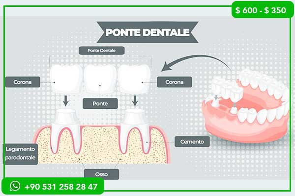 Prix des implants dentaires en Pologne vs Turquie – 7 raisons de choisir la Turquie !