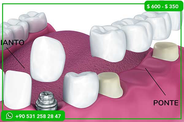 Precios de Implantes Dentales en Finlandia vs Turquía – ¡7 Razones para Elegir Turquía!