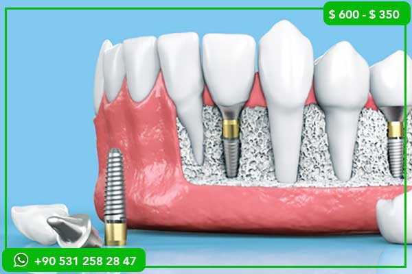 Veneers Cost Turkey: 21 Expert Insights You Must Know Before Getting a Perfect Smile (2026 Guide)