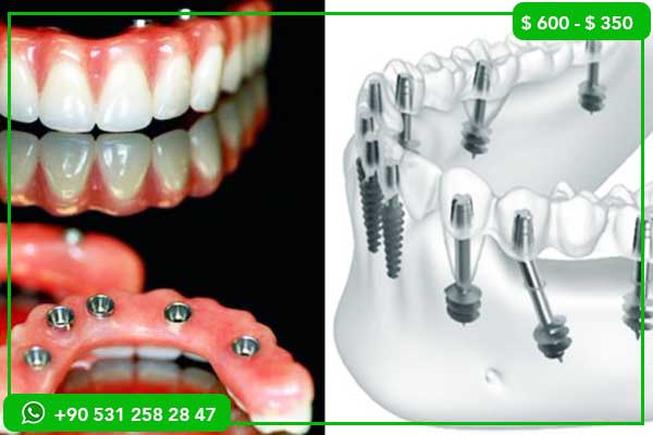 Full Mouth Veneers Turkey: 23 Expert Insights for a Complete Smile Transformation (2026 Guide)