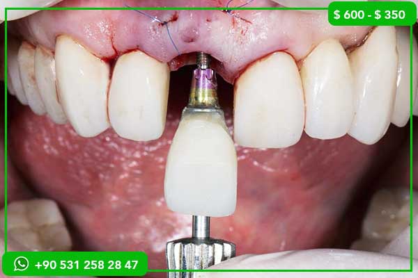 Veneers Risks: 17 Honest Facts You Must Know Before Getting Dental Veneers