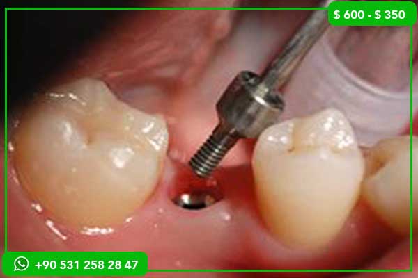 Best City for Dental Treatment in Turkey: Top 5 Cities Compared (2026 Guide)