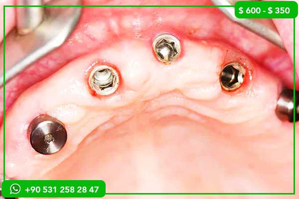 Is It Safe to Get Dental Treatment in Turkey? Complete 2026 Safety, Risks & Patient Guide