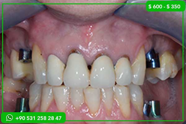 Faccette dentali Emax prezzi Turchia